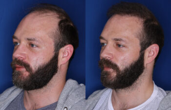 37 year old male 7 months post 2,500 graft transplant