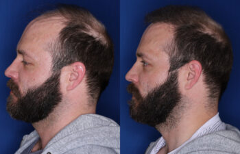 37 year old male 7 months post 2,500 graft transplant