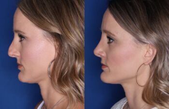 Side-by-side profile photos of a woman before and after a cosmetic procedure showing reduced fullness under the chin and improved jawline definition against a blue background.