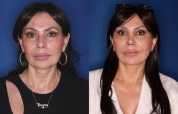 59 year old female 11 months post revision upper blepharoplasty, revision KalosLift extended deep plane facelift with platysmaplasty neck lift, and 3 months post open rhinoplasty with alar base reduction