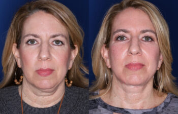52 year old female 4 months post KalosLift extended deep plane facelift with platysmaplasty neck lift and upper blepharoplasty