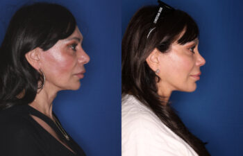 59 year old female 11 months post revision upper blepharoplasty, revision KalosLift extended deep plane facelift with platysmaplasty neck lift, and 3 months post open rhinoplasty with alar base reduction