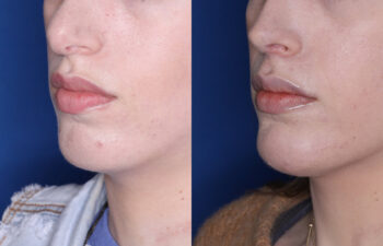 30 year old female 6 months post silicone chin implant and revision rhinoplasty