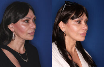 59 year old female 11 months post revision upper blepharoplasty, revision KalosLift extended deep plane facelift with platysmaplasty neck lift, and 3 months post open rhinoplasty with alar base reduction