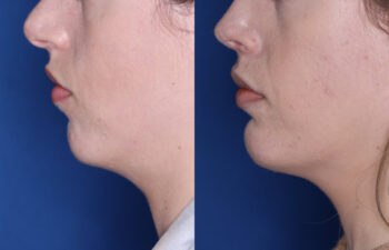 30 year old female 6 months post silicone chin implant and revision rhinoplasty