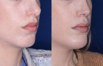 30 year old female 6 months post silicone chin implant and revision rhinoplasty
