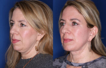 52 year old female 4 months post KalosLift extended deep plane facelift with platysmaplasty neck lift and upper blepharoplasty