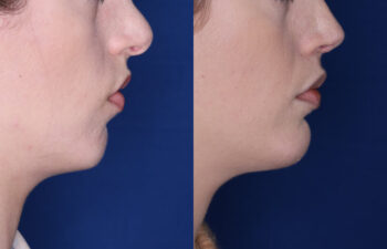 30 year old female 6 months post silicone chin implant and revision rhinoplasty