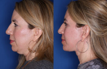 52 year old female 4 months post KalosLift extended deep plane facelift with platysmaplasty neck lift and upper blepharoplasty