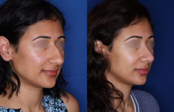 30 year old female 10 months post rhinoplasty