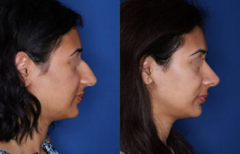 30 year old female 10 months post rhinoplasty