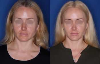 34 year old female 12 months post revision rhinoplasty