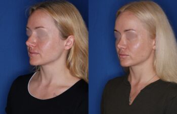 34 year old female 12 months post revision rhinoplasty