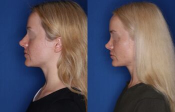 34 year old female 12 months post revision rhinoplasty