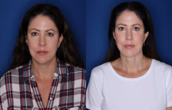 front of before and after photos of the 48 year old female 12 months post KalosLift extended deep plane facelift with platysmaplasty neck lift and fat transposition lower blepharoplasty