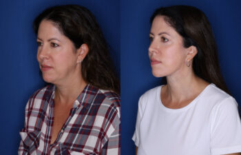 profile of before and after photos of the 48 year old female 12 months post KalosLift extended deep plane facelift with platysmaplasty neck lift and fat transposition lower blepharoplasty