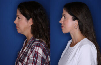 profile of before and after photos of the 48 year old female 12 months post KalosLift extended deep plane facelift with platysmaplasty neck lift and fat transposition lower blepharoplasty