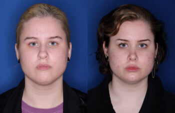 20 year old female 6 months post rhinoplasty