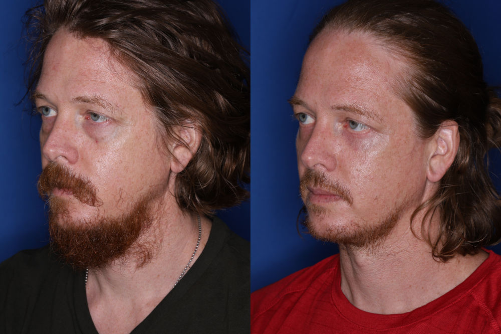 35 year old male 4 months post fat transposition lower blepharoplasty