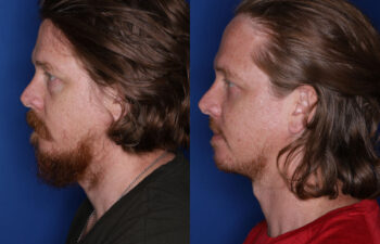 35 year old male 4 months post fat transposition lower blepharoplasty