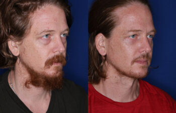 35 year old male 4 months post fat transposition lower blepharoplasty