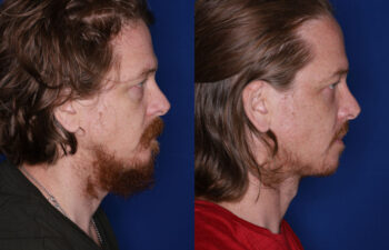 35 year old male 4 months post fat transposition lower blepharoplasty
