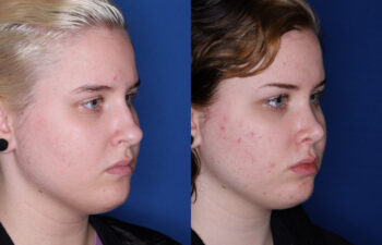 20 year old female 6 months post rhinoplasty