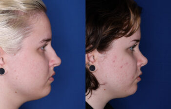 20 year old female 6 months post rhinoplasty