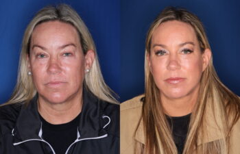 51 year old female 5 months post upper blepharoplasty, fat transposition lower blepharoplasty, and KalosLift extended deep plane facelift with platysmaplasty neck lift
