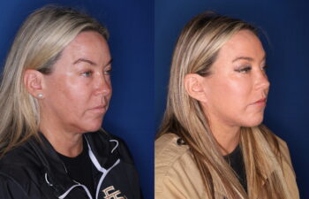 51 year old female 5 months post upper blepharoplasty, fat transposition lower blepharoplasty, and KalosLift extended deep plane facelift with platysmaplasty neck lift