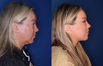 51 year old female 5 months post upper blepharoplasty, fat transposition lower blepharoplasty, and KalosLift extended deep plane facelift with platysmaplasty neck lift