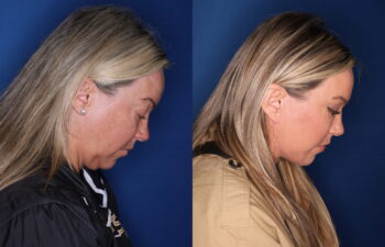 51 year old female 5 months post upper blepharoplasty, fat transposition lower blepharoplasty, and KalosLift extended deep plane facelift with platysmaplasty neck lift