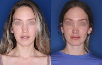 Side-by-side photos of a woman before (left) and after (right) a cosmetic procedure, both with blurred eyes against a blue background.