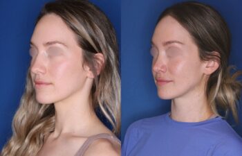 Side-by-side photos of a woman with blurred eyes, showing her face from the left side in similar lighting and blue background, with different hairstyles and tops.