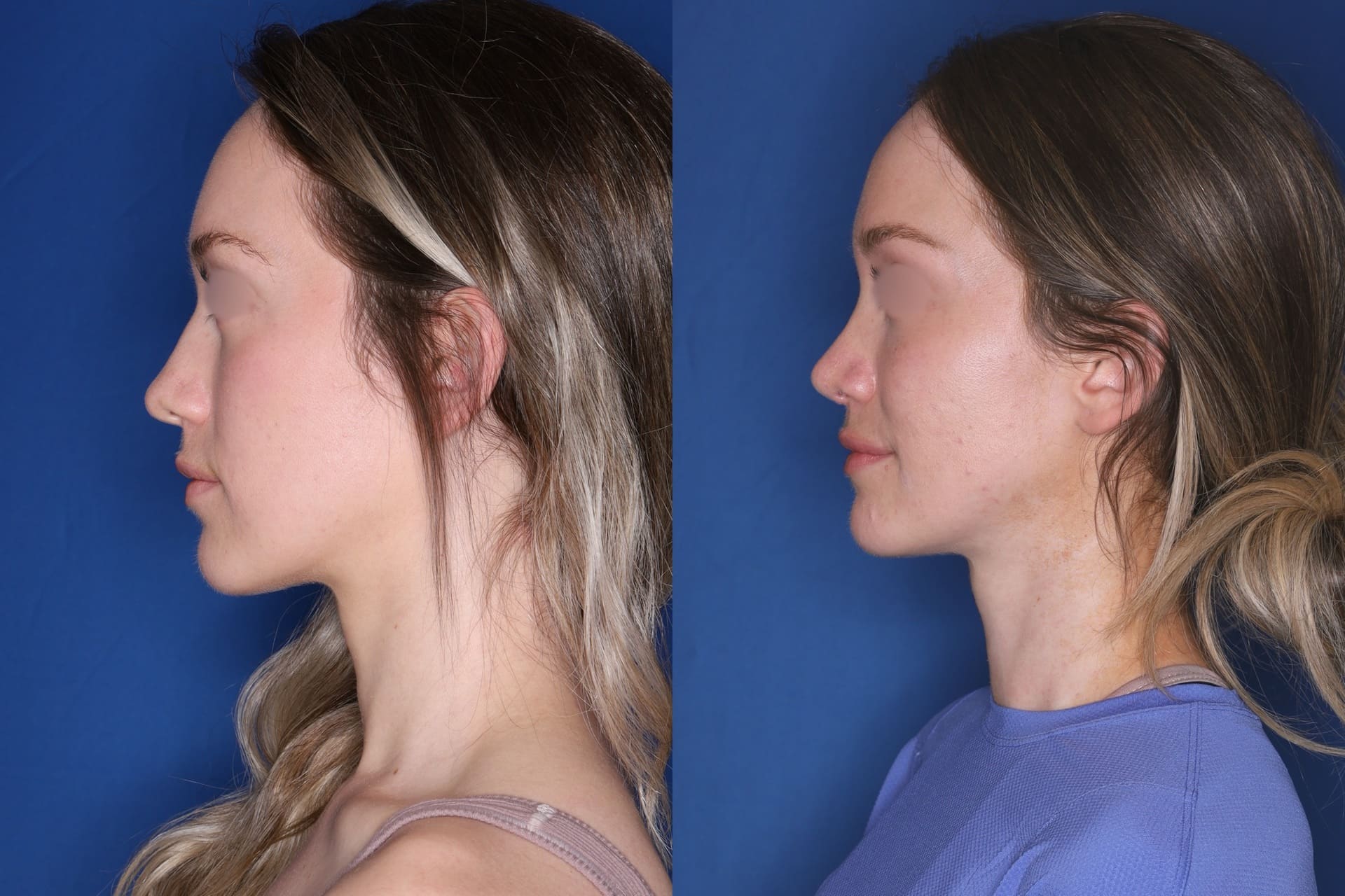 Side-by-side profile photos of a woman with blurred eyes, showing before and after results of a cosmetic procedure against a blue background.