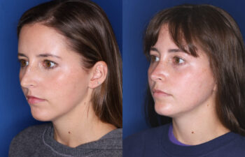 Side-by-side photos of a woman before and after a procedure, showing subtle changes in her facial appearance against a blue background.