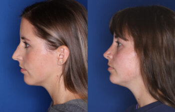Side-by-side profile photos of a woman before and after a procedure, showing changes in jawline and neck contours against a blue background.