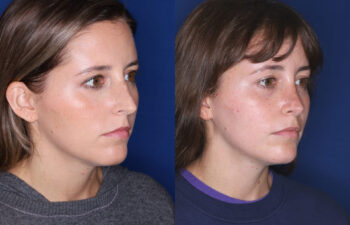 Side-by-side photos of a woman facing right, showing slight differences in facial appearance, lighting, and hair between the two images, both set against a blue background.