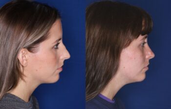 Side-by-side profile photos of two women with straight faces, both against a blue background, showing differences in their facial features and jawlines.