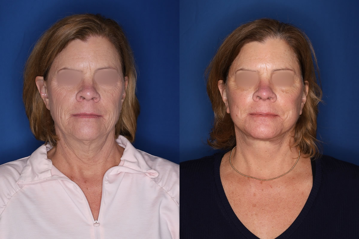 Side-by-side photos of the same middle-aged woman against a blue background, showing her face before and after a cosmetic procedure; eyes are blurred for privacy.