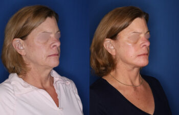 Side-by-side comparison of a middle-aged woman before and after a cosmetic procedure, showing smoother skin and reduced wrinkles.