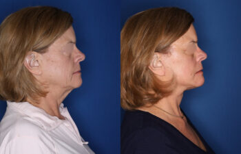 Side-by-side profile photos of a woman before and after a cosmetic procedure, showing changes to the jawline, neck, and facial contours against a blue background.