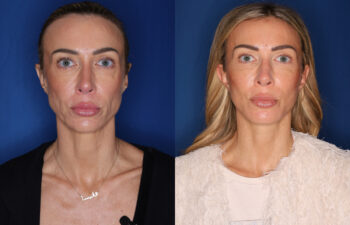 photo before and after - 45 year old female 5 months post KalosLift extended deep plane facelift with platysmaplasty neck lift