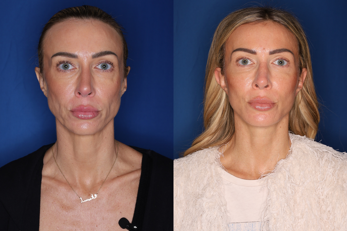 photo before and after - 45 year old female 5 months post KalosLift extended deep plane facelift with platysmaplasty neck lift