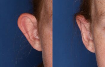 Side-by-side comparison of a person's ear before (left) and after (right) a cosmetic procedure, showing reduced prominence of the ear.