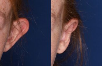 Side-by-side comparison of a person's left ear before (left) and after (right) a cosmetic procedure against a dark blue background.