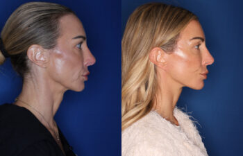 photo before and after - 45 year old female 5 months post KalosLift extended deep plane facelift with platysmaplasty neck lift