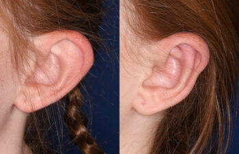 Side-by-side close-up of a person's ear before (left) and after (right) a surgical procedure, showing changes in ear shape.