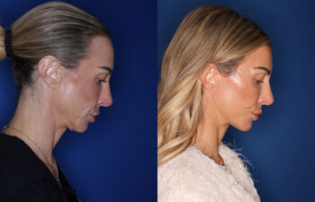 photo before and after - 45 year old female 5 months post KalosLift extended deep plane facelift with platysmaplasty neck lift