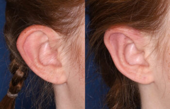 Side-by-side comparison of a person's ear before and after a medical or cosmetic procedure, showing changes in ear shape and contour.